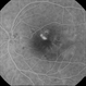 Central Serous Retinopathy (CSR) Central Serous Retinopathy (CSR)